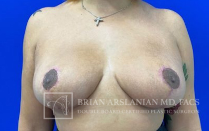 Breast Lift case #4390