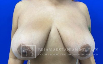 Breast Lift case #4390