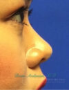 Fillers case #3496