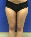 Liposuction case #3617