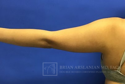 Liposuction case #3599