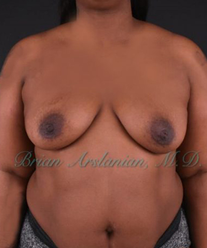 Breast Augmentation case #2521