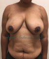 Breast Reduction case #2923