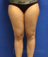 Liposuction case #3617