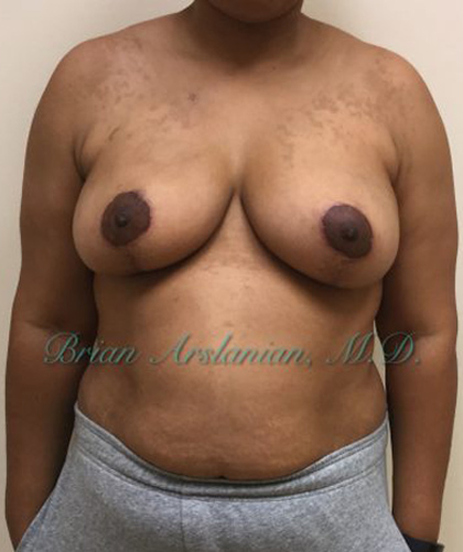Breast Reduction case #2923