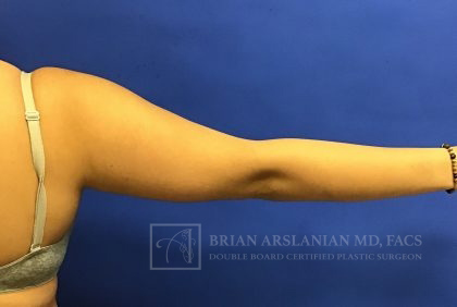 Liposuction case #3599