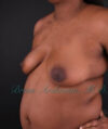 Breast Augmentation case #2521
