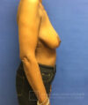 Breast Reconstruction case #2863