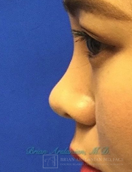 Fillers case #3496