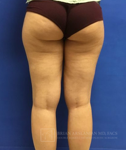 Liposuction case #3617