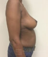 Breast Reconstruction case #2863