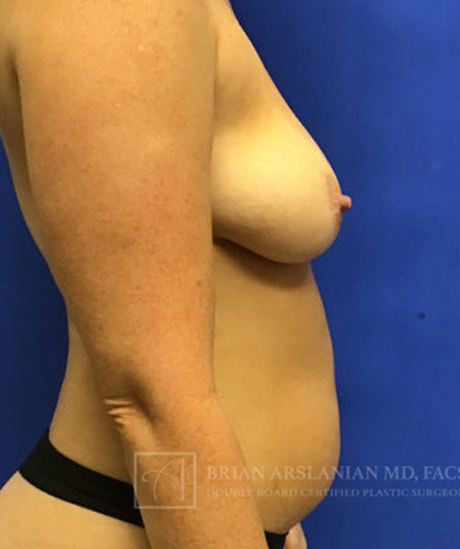 Breast Implants and Lift case #3025