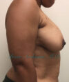 Breast Reduction case #2923