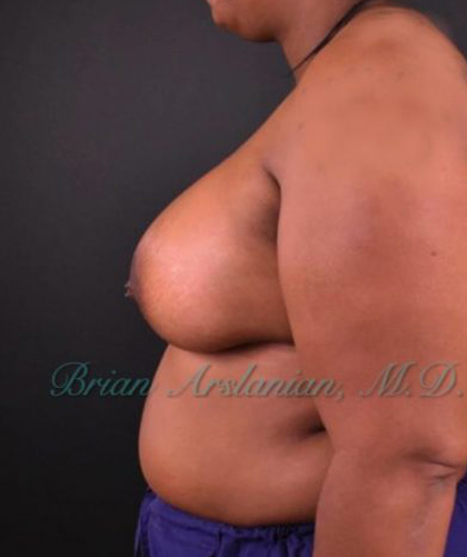 Breast Augmentation case #2521