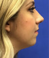 Chin Implant case #2787