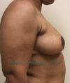 Breast Reduction case #2923