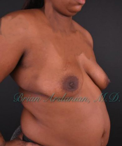 Breast Augmentation case #2521