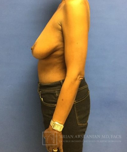Breast Reconstruction case #2863