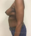 Breast Reconstruction case #2863