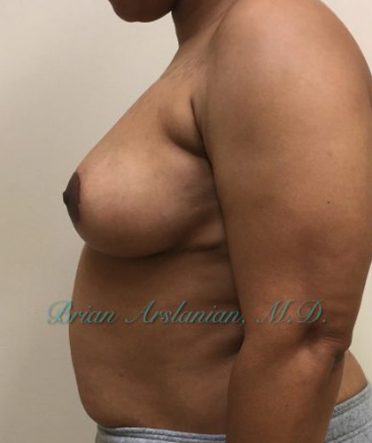 Breast Reduction case #2923