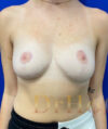 Breast Implants and Lift case #3036