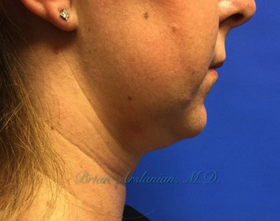 | Arslanian Plastic Surgery Atlanta Before & After Plastic Surgery Results | facial procedure