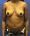Liposuction case #3623