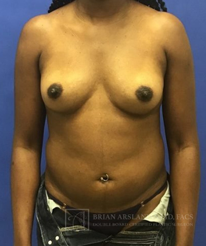 Liposuction case #3623