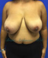 Breast Reduction case #2934