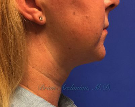 | Arslanian Plastic Surgery Atlanta Before & After Plastic Surgery Results | facial procedure