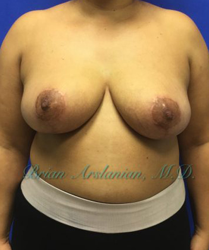 | Arslanian Plastic Surgery Atlanta Before & After Plastic Surgery Results | breast procedure