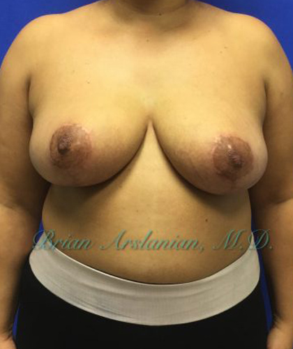 Breast Reduction case #2934