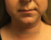 Kybella case #2799