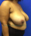 Breast Reduction case #2934