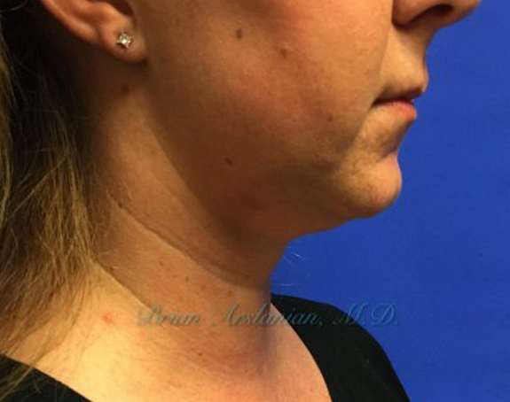 Kybella case #2799