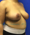 Breast Reduction case #2934