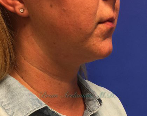 Kybella case #2799