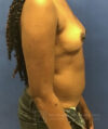 Liposuction case #3623