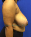 Breast Reduction case #2934