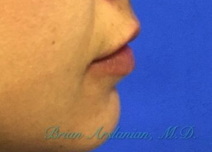 Fillers case #3501