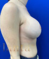 Breast Implants and Lift case #3036