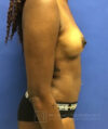 Liposuction case #3623