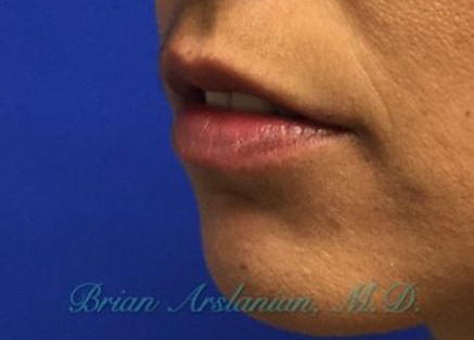 Fillers case #3501