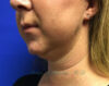 Kybella case #2799