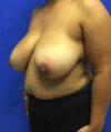 Breast Reduction case #2934