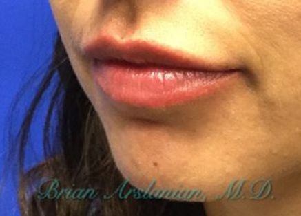 Fillers case #3501