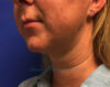 Kybella case #2799