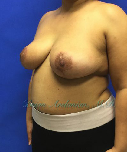 Breast Reduction case #2934