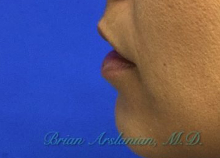 Fillers case #3501