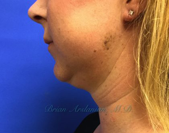 Kybella case #2799